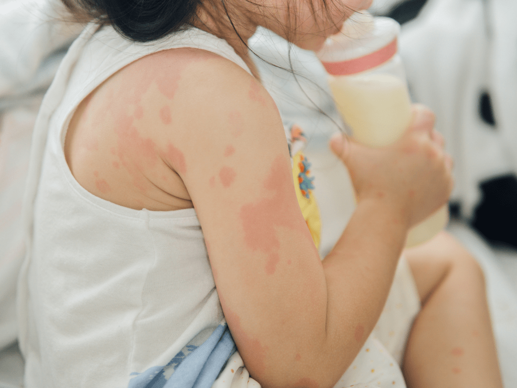 Alergia a la frutilla