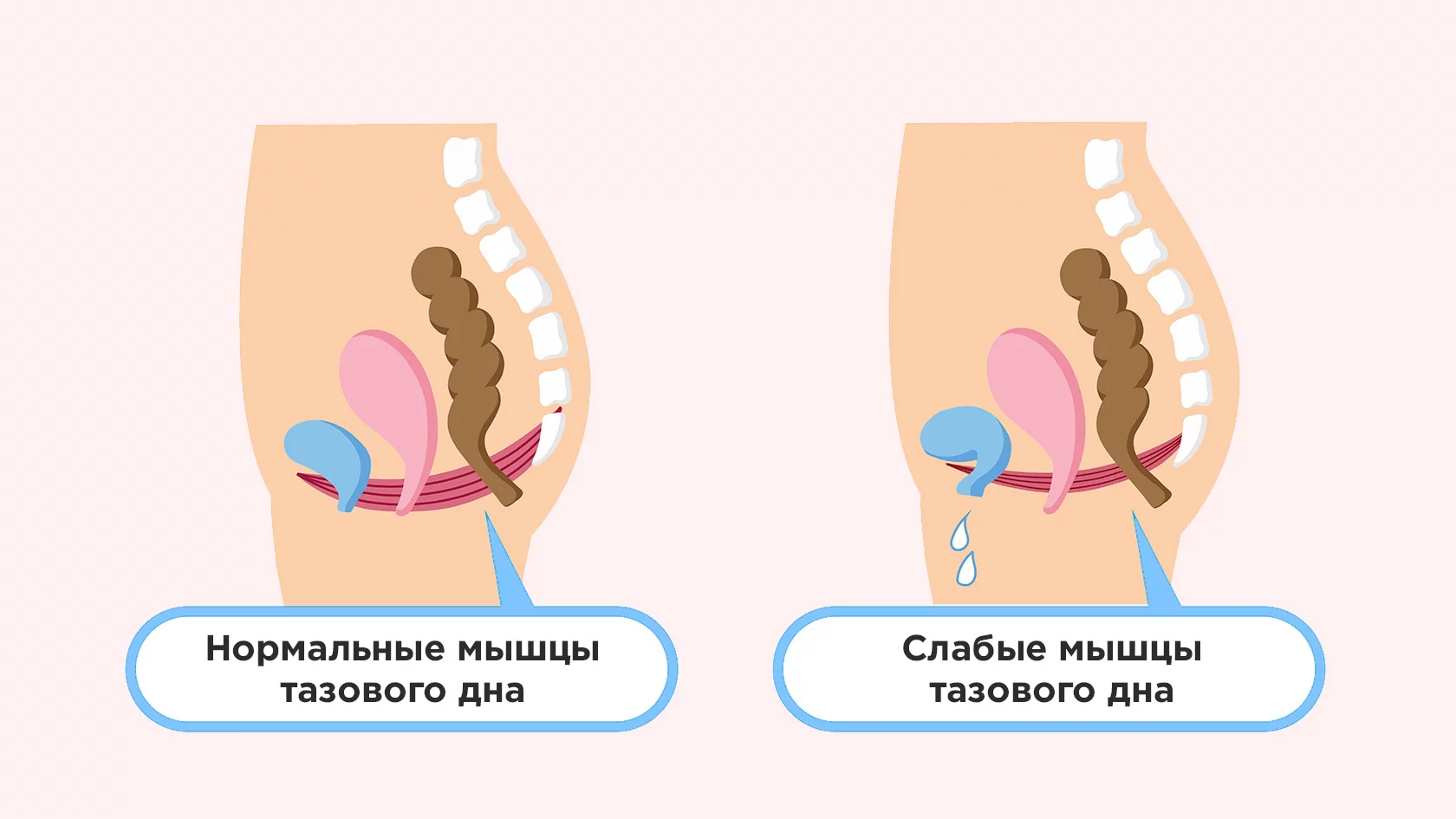 Лечение разрыва шейки матки в Ихилов